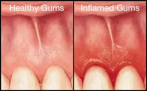 Healthy vs inflamed gums comparison
