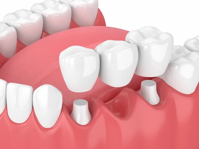 Dental bridge model showing prosthetic tooth held by crowns