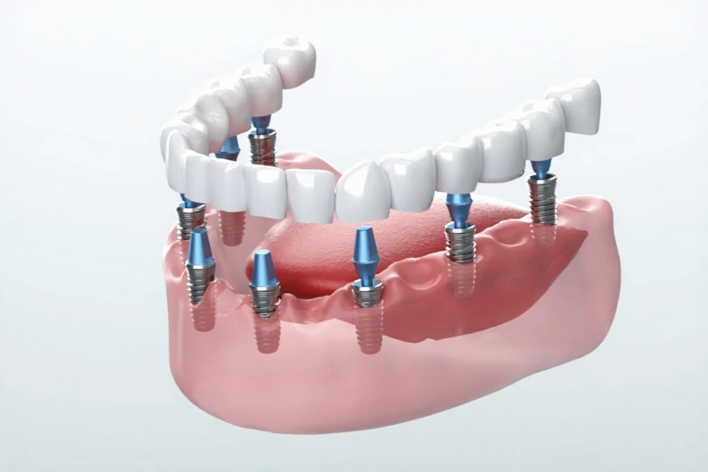 Dental implant model showing titanium post integrated into jawbone with ceramic crown